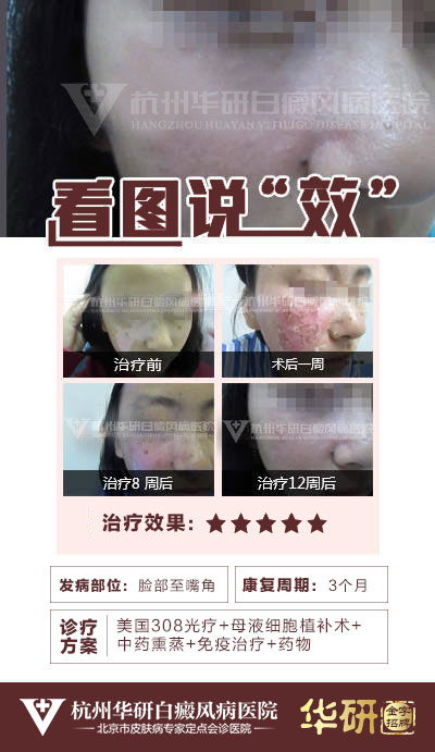 富阳区哪里诊疗白癜风诊疗？